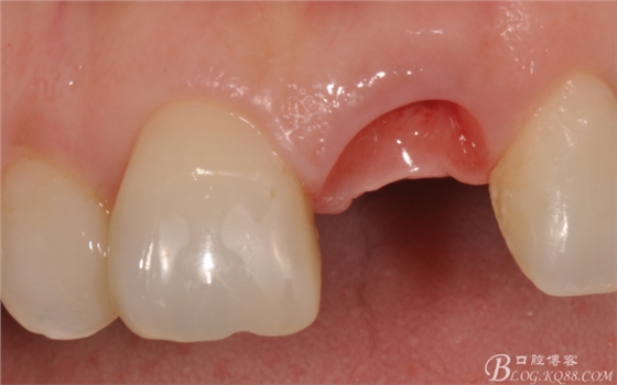 種植美學軟組織塑形(原創(chuàng)不得轉載) 種植美學軟組織塑形(原創(chuàng)不得轉載)