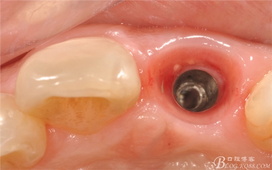 種植美學軟組織塑形(原創(chuàng)不得轉載) 種植美學軟組織塑形(原創(chuàng)不得轉載)