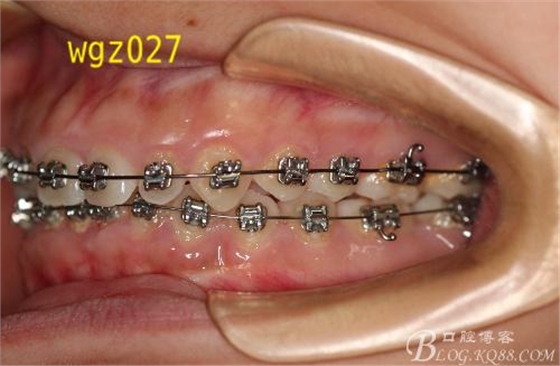 這樣的深覆合不用平導能夠打開咬合嗎？（原創(chuàng)）