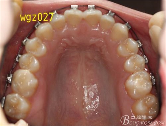 這樣的深覆合不用平導能夠打開咬合嗎？（原創(chuàng)）