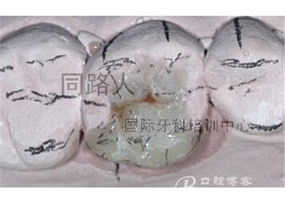 樹脂嵌體制作的階段性總結 樹脂嵌體制作的階段性總結