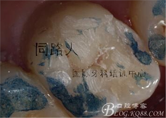 樹脂嵌體制作的階段性總結 樹脂嵌體制作的階段性總結