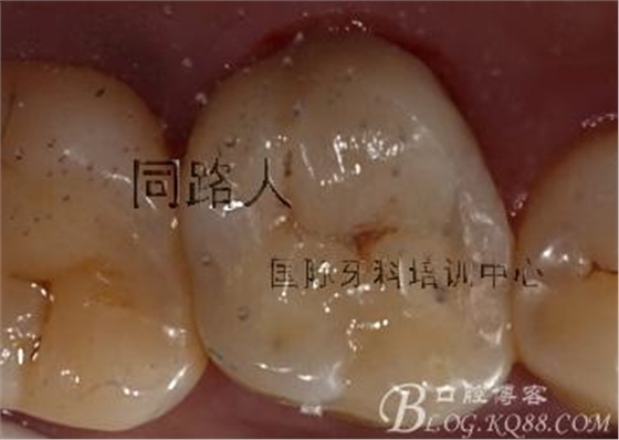 樹脂嵌體制作的階段性總結 樹脂嵌體制作的階段性總結