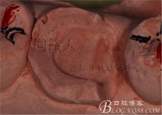 樹脂嵌體制作的階段性總結 樹脂嵌體制作的階段性總結