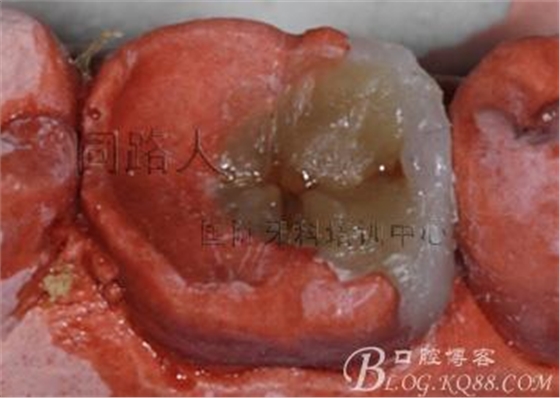 樹脂嵌體制作的階段性總結 樹脂嵌體制作的階段性總結