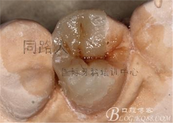 樹脂嵌體制作的階段性總結 樹脂嵌體制作的階段性總結