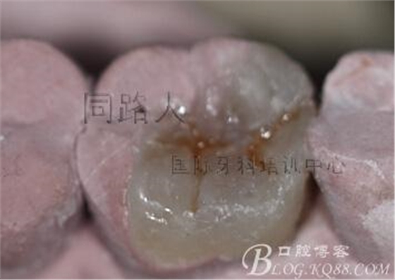 樹脂嵌體制作的階段性總結 樹脂嵌體制作的階段性總結