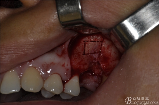 上頜竇外提一例