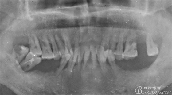 重度牙周炎的咬合重建修復(fù)兩年后效果--塘沽牙醫(yī)吳世超 重度牙周炎的咬合重建修復(fù)兩年后效果--塘沽牙醫(yī)吳世超