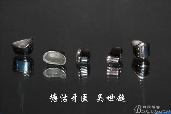 重度牙周炎的咬合重建修復(fù)兩年后效果--塘沽牙醫(yī)吳世超 重度牙周炎的咬合重建修復(fù)兩年后效果--塘沽牙醫(yī)吳世超