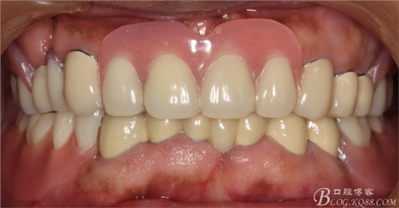 重度牙周炎的咬合重建修復(fù)兩年后效果--塘沽牙醫(yī)吳世超 重度牙周炎的咬合重建修復(fù)兩年后效果--塘沽牙醫(yī)吳世超