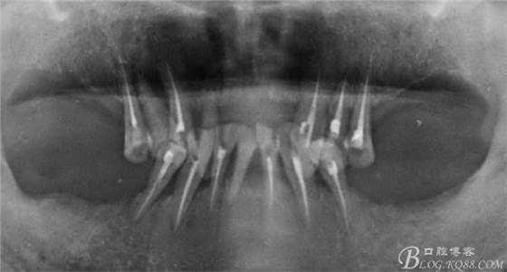 重度牙周炎的咬合重建修復(fù)兩年后效果--塘沽牙醫(yī)吳世超 重度牙周炎的咬合重建修復(fù)兩年后效果--塘沽牙醫(yī)吳世超
