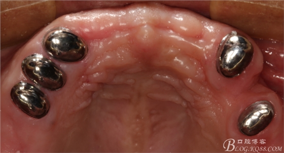 重度牙周炎的咬合重建修復(fù)兩年后效果--塘沽牙醫(yī)吳世超 重度牙周炎的咬合重建修復(fù)兩年后效果--塘沽牙醫(yī)吳世超