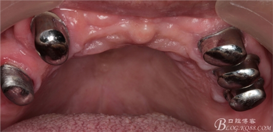 重度牙周炎的咬合重建修復(fù)兩年后效果--塘沽牙醫(yī)吳世超 重度牙周炎的咬合重建修復(fù)兩年后效果--塘沽牙醫(yī)吳世超