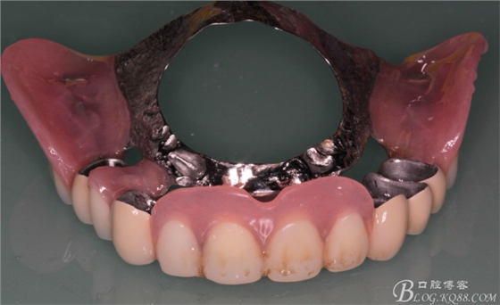 重度牙周炎的咬合重建修復(fù)兩年后效果--塘沽牙醫(yī)吳世超 重度牙周炎的咬合重建修復(fù)兩年后效果--塘沽牙醫(yī)吳世超