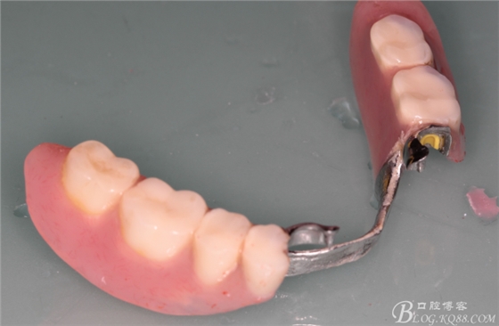 重度牙周炎的咬合重建修復(fù)兩年后效果--塘沽牙醫(yī)吳世超 重度牙周炎的咬合重建修復(fù)兩年后效果--塘沽牙醫(yī)吳世超