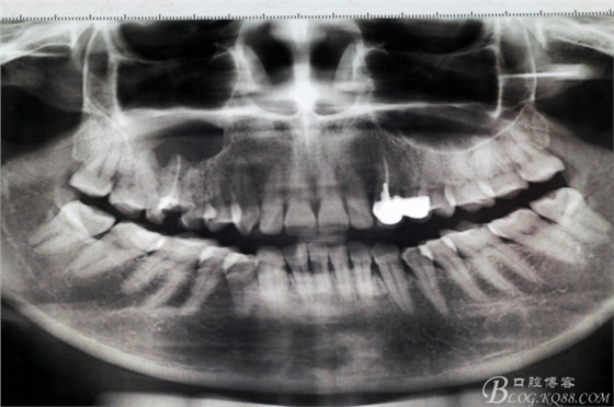 上頜磨牙區(qū)囊腫摘除+根尖切除術(shù)
