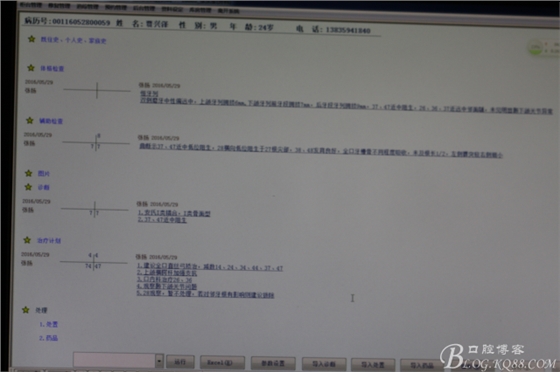 雙側(cè)下頜第二磨牙阻生牙的微創(chuàng)拔除 雙側(cè)下頜第二磨牙阻生牙的微創(chuàng)拔除