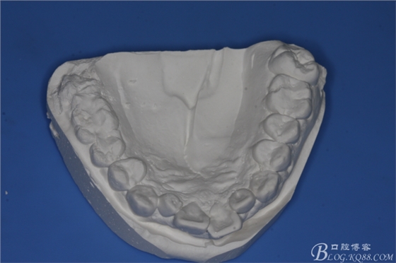 雙側(cè)下頜第二磨牙阻生牙的微創(chuàng)拔除 雙側(cè)下頜第二磨牙阻生牙的微創(chuàng)拔除