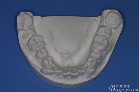 雙側(cè)下頜第二磨牙阻生牙的微創(chuàng)拔除 雙側(cè)下頜第二磨牙阻生牙的微創(chuàng)拔除