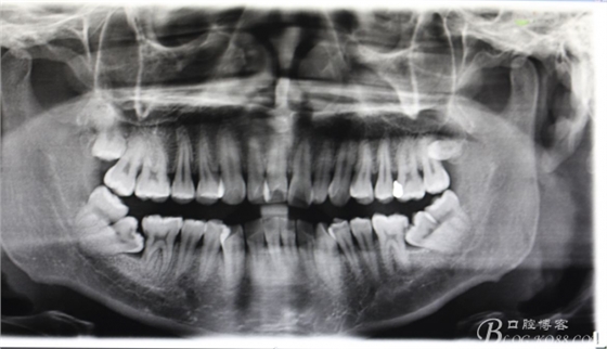 雙側(cè)下頜第二磨牙阻生牙的微創(chuàng)拔除 雙側(cè)下頜第二磨牙阻生牙的微創(chuàng)拔除