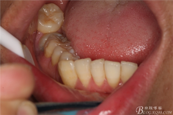 雙側(cè)下頜第二磨牙阻生牙的微創(chuàng)拔除 雙側(cè)下頜第二磨牙阻生牙的微創(chuàng)拔除