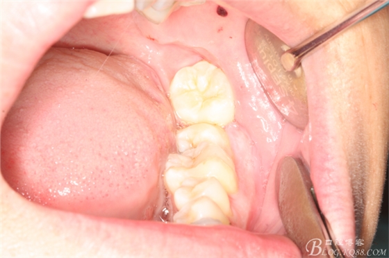 雙側(cè)下頜第二磨牙阻生牙的微創(chuàng)拔除 雙側(cè)下頜第二磨牙阻生牙的微創(chuàng)拔除