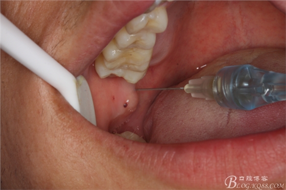 雙側(cè)下頜第二磨牙阻生牙的微創(chuàng)拔除 雙側(cè)下頜第二磨牙阻生牙的微創(chuàng)拔除