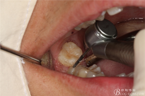 雙側(cè)下頜第二磨牙阻生牙的微創(chuàng)拔除 雙側(cè)下頜第二磨牙阻生牙的微創(chuàng)拔除