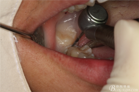 雙側(cè)下頜第二磨牙阻生牙的微創(chuàng)拔除 雙側(cè)下頜第二磨牙阻生牙的微創(chuàng)拔除