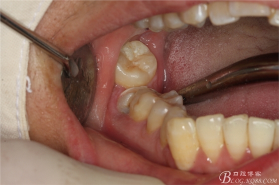 雙側(cè)下頜第二磨牙阻生牙的微創(chuàng)拔除 雙側(cè)下頜第二磨牙阻生牙的微創(chuàng)拔除