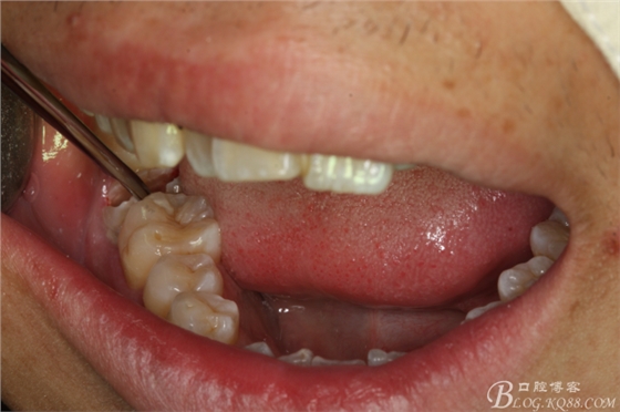 雙側(cè)下頜第二磨牙阻生牙的微創(chuàng)拔除 雙側(cè)下頜第二磨牙阻生牙的微創(chuàng)拔除