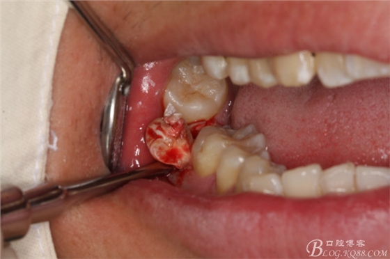雙側(cè)下頜第二磨牙阻生牙的微創(chuàng)拔除 雙側(cè)下頜第二磨牙阻生牙的微創(chuàng)拔除