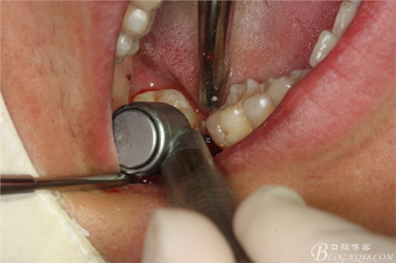 雙側(cè)下頜第二磨牙阻生牙的微創(chuàng)拔除 雙側(cè)下頜第二磨牙阻生牙的微創(chuàng)拔除