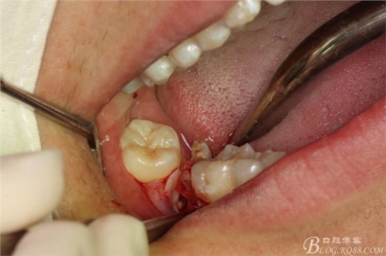 雙側(cè)下頜第二磨牙阻生牙的微創(chuàng)拔除 雙側(cè)下頜第二磨牙阻生牙的微創(chuàng)拔除