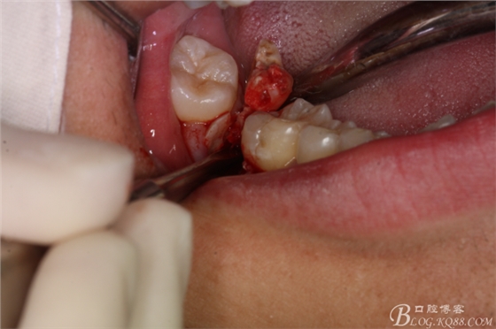 雙側(cè)下頜第二磨牙阻生牙的微創(chuàng)拔除 雙側(cè)下頜第二磨牙阻生牙的微創(chuàng)拔除
