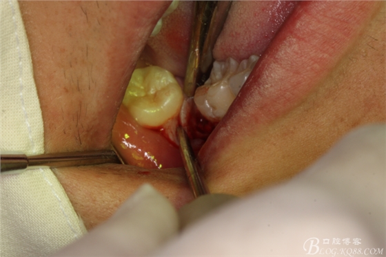 雙側(cè)下頜第二磨牙阻生牙的微創(chuàng)拔除 雙側(cè)下頜第二磨牙阻生牙的微創(chuàng)拔除