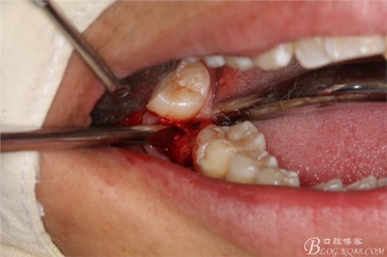 雙側(cè)下頜第二磨牙阻生牙的微創(chuàng)拔除 雙側(cè)下頜第二磨牙阻生牙的微創(chuàng)拔除