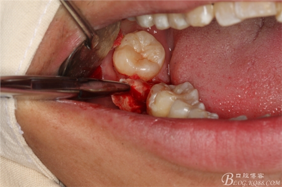 雙側(cè)下頜第二磨牙阻生牙的微創(chuàng)拔除 雙側(cè)下頜第二磨牙阻生牙的微創(chuàng)拔除