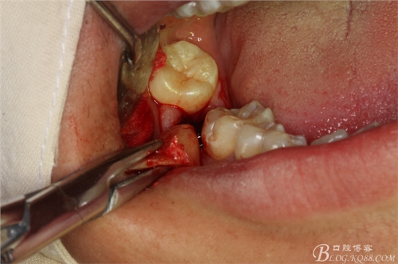 雙側(cè)下頜第二磨牙阻生牙的微創(chuàng)拔除 雙側(cè)下頜第二磨牙阻生牙的微創(chuàng)拔除