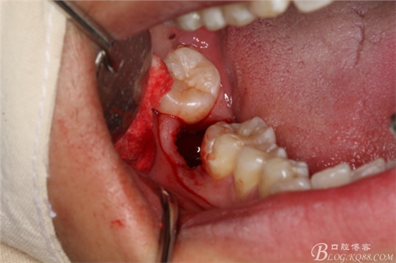雙側(cè)下頜第二磨牙阻生牙的微創(chuàng)拔除 雙側(cè)下頜第二磨牙阻生牙的微創(chuàng)拔除