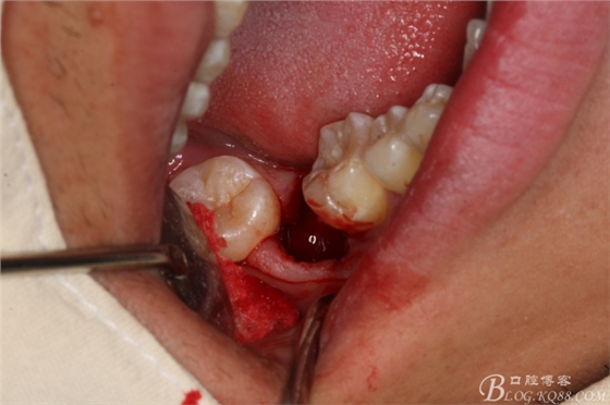 雙側(cè)下頜第二磨牙阻生牙的微創(chuàng)拔除 雙側(cè)下頜第二磨牙阻生牙的微創(chuàng)拔除