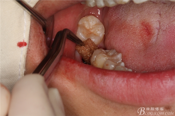 雙側(cè)下頜第二磨牙阻生牙的微創(chuàng)拔除 雙側(cè)下頜第二磨牙阻生牙的微創(chuàng)拔除