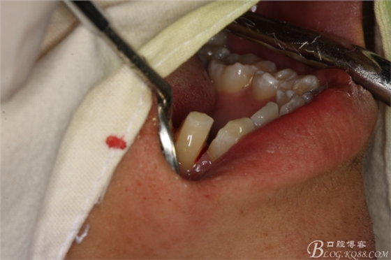 雙側(cè)下頜第二磨牙阻生牙的微創(chuàng)拔除 雙側(cè)下頜第二磨牙阻生牙的微創(chuàng)拔除