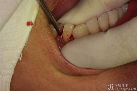 雙側(cè)下頜第二磨牙阻生牙的微創(chuàng)拔除 雙側(cè)下頜第二磨牙阻生牙的微創(chuàng)拔除