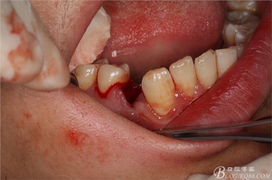 雙側(cè)下頜第二磨牙阻生牙的微創(chuàng)拔除 雙側(cè)下頜第二磨牙阻生牙的微創(chuàng)拔除