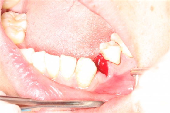 雙側(cè)下頜第二磨牙阻生牙的微創(chuàng)拔除 雙側(cè)下頜第二磨牙阻生牙的微創(chuàng)拔除