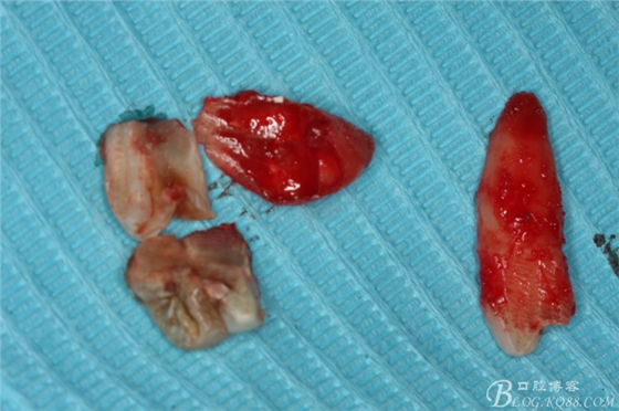 雙側(cè)下頜第二磨牙阻生牙的微創(chuàng)拔除 雙側(cè)下頜第二磨牙阻生牙的微創(chuàng)拔除