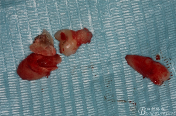 雙側(cè)下頜第二磨牙阻生牙的微創(chuàng)拔除 雙側(cè)下頜第二磨牙阻生牙的微創(chuàng)拔除