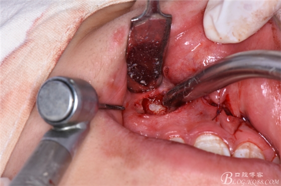 雙切口拔除鼻底埋伏多生牙